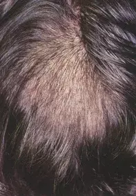 Fig 1. Diffuse alopecia