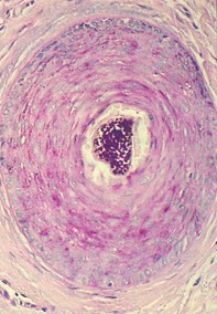 Fig 2. Scalp biopsy