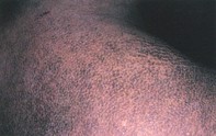 Fig 1. Hyperpigmentation