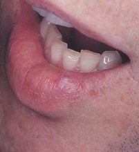 Fig 1. Translucent nodule