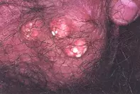 Fig 1. Scrotal nodules Fig 1. Scrotal nodules