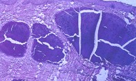Fig 2. Scrotal biopsy