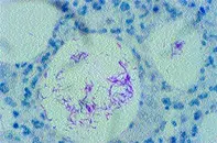 Fig 2. Skin biopsy