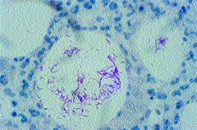 Fig 2. Skin biopsy