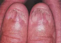 Fig 1. Atrophic nail plates