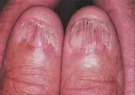 Fig 1. Atrophic nail plates Fig 1. Atrophic nail plates