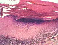 Fig 2. Lymphocytic infiltrate