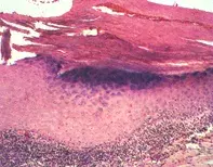 Fig 2. Lymphocytic infiltrate Fig 2. Lymphocytic infiltrate