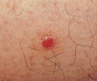 Fig 1. Red papule
