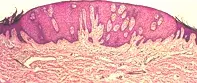 Fig 2. Excision biopsy