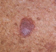 Fig 1. Inflamed solar lentigo