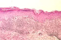 Fig 2. Skin biopsy