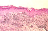 Fig 2. Skin biopsy