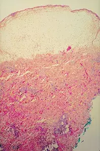 Fig 2. Skin biopsy