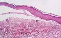 Fig 2. Skin biopsy