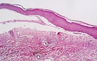 Fig 2. Skin biopsy
