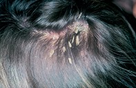 Fig 1. Hair scale