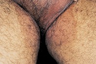 Fig 1. Pigmented rash