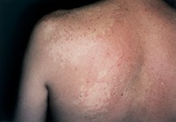 Fig 1. Hypopigmented patches