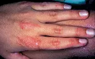 Fig 1. Erythema