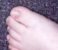 Toe lesions.