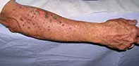 Fig 1. Arm rash