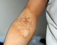 Fig 1a. Irritated rash Fig 1a. Irritated rash