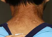 Fig 1b. Irritated rash Fig 1b. Irritated rash