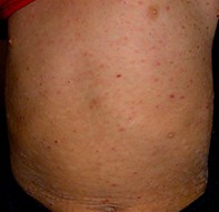 Fig 1. Rash