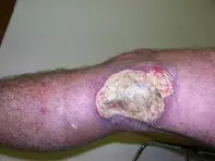 Fig 1. Leg ulcer