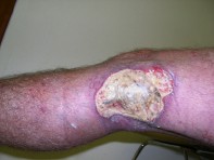 Fig 1. Leg ulcer