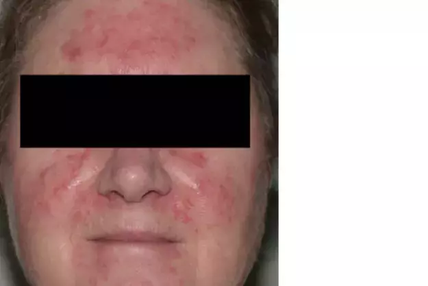 Clinical picture of Case 2 showing an erythematous scaly skin rash at
