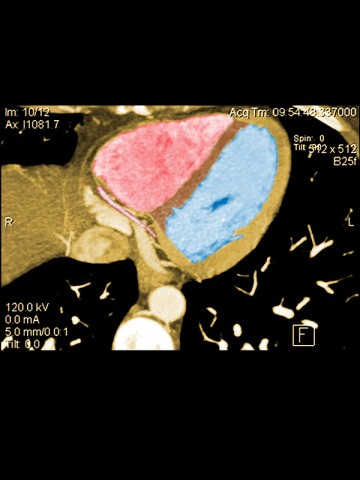 © MEDICAL BODY SCANS/SPL