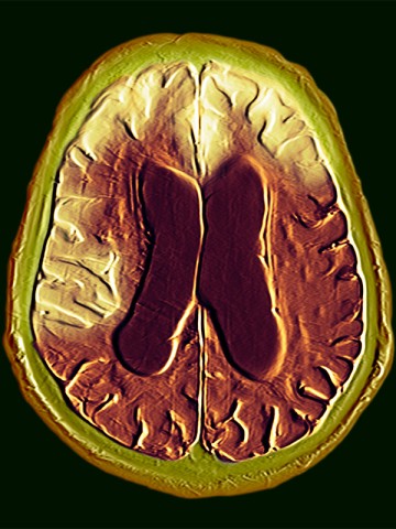 Frontotemporal dementia (combined MRI and CT). © DR P. MARAZZI/SPL