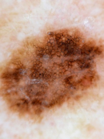 Malignant melanoma © CID/SPL