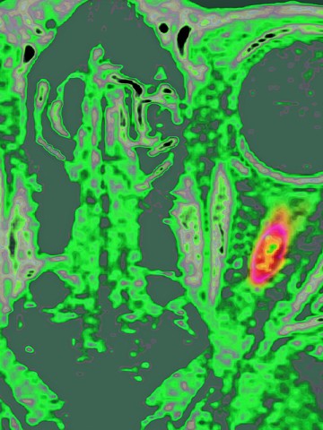 Multiple sclerosis in the optic nerve (MRI) © JAMES CAVALLINI/SPL
