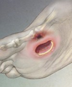 © SCIENCE SOURCE/MICHELE S. GRAHAM/MEDICAL IMAGES