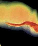 © ISM/SOVEREIGN/MEdICAL IMAGES X-RAY SHOWING CANCER OF THE GLANS PENIS ANd URETHRA