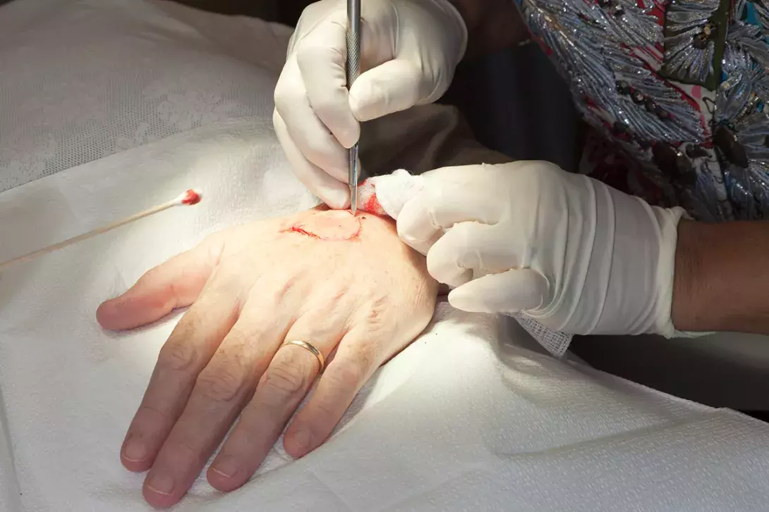 A New Form of Noninvasive Wound Closure With a Surgical Zipper