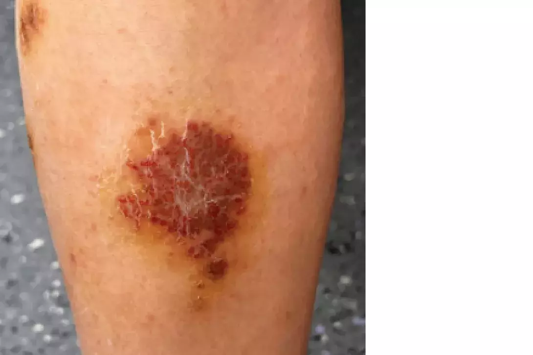 Tinea capitis in an elderly female showing crusting, pu