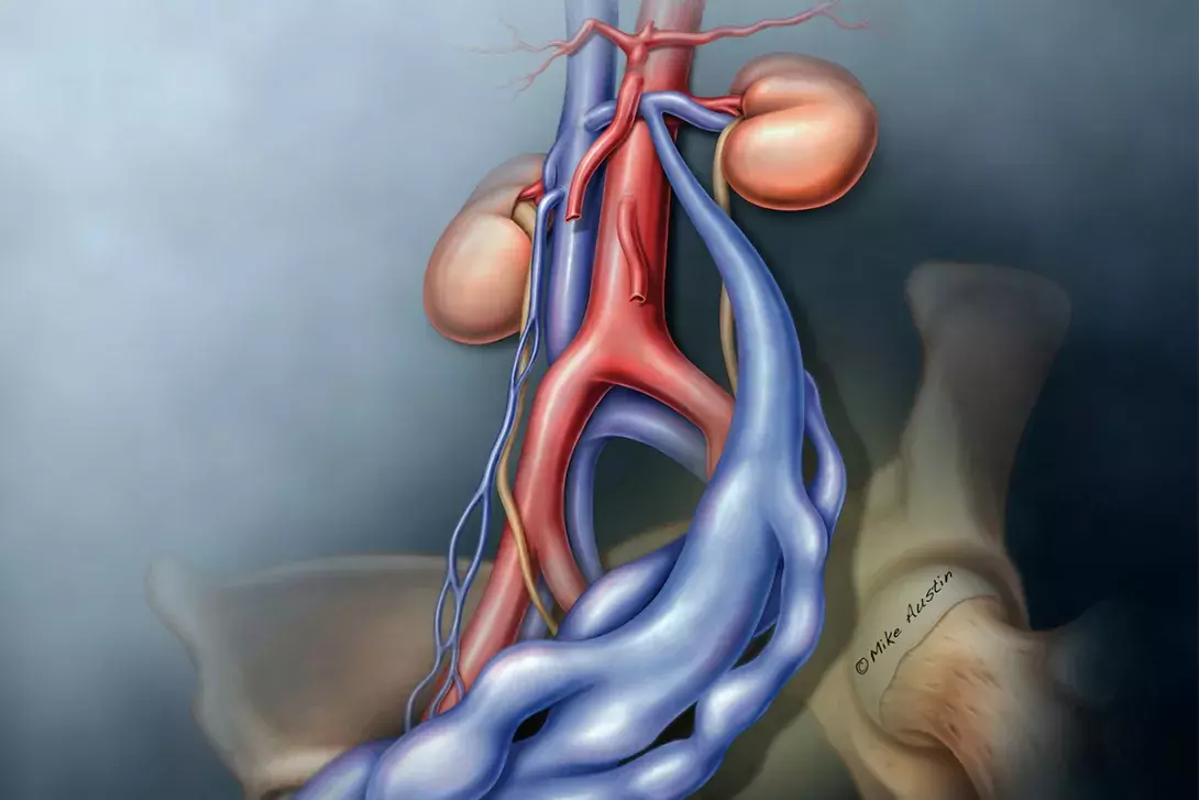 Pelvic venous disorders. Embracing the new SVP classification