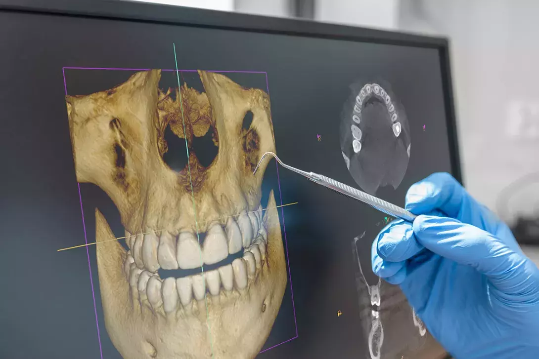 A dental trauma case in a snowy day - AbuMaizar Dental Roots Clinic