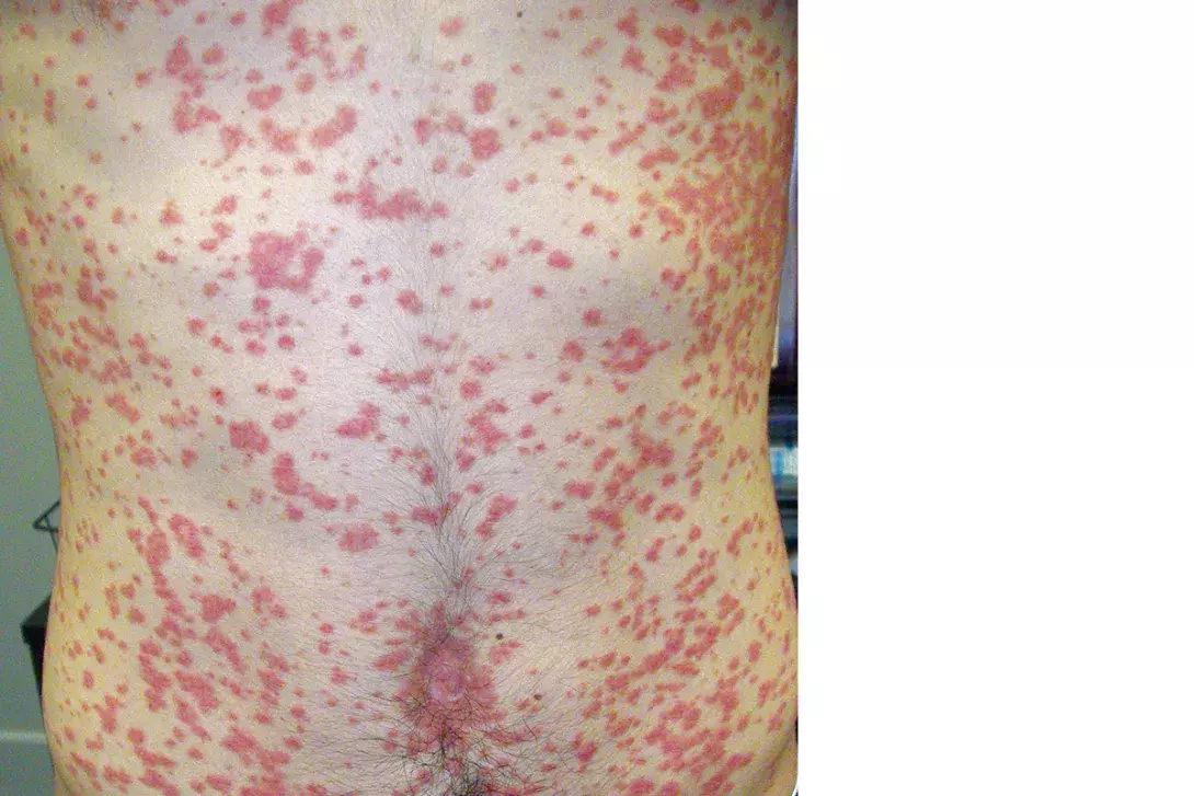 A man with a rapidly evolving, widespread pruritic rash
