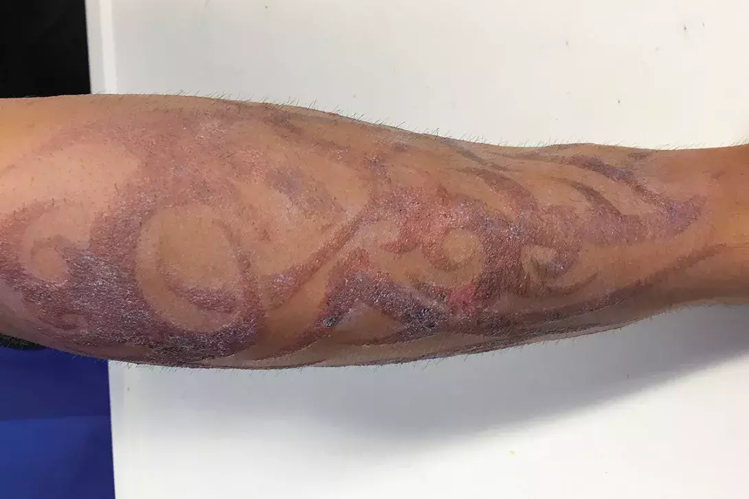 A returned traveller with a tattoo rash | Medicine Today