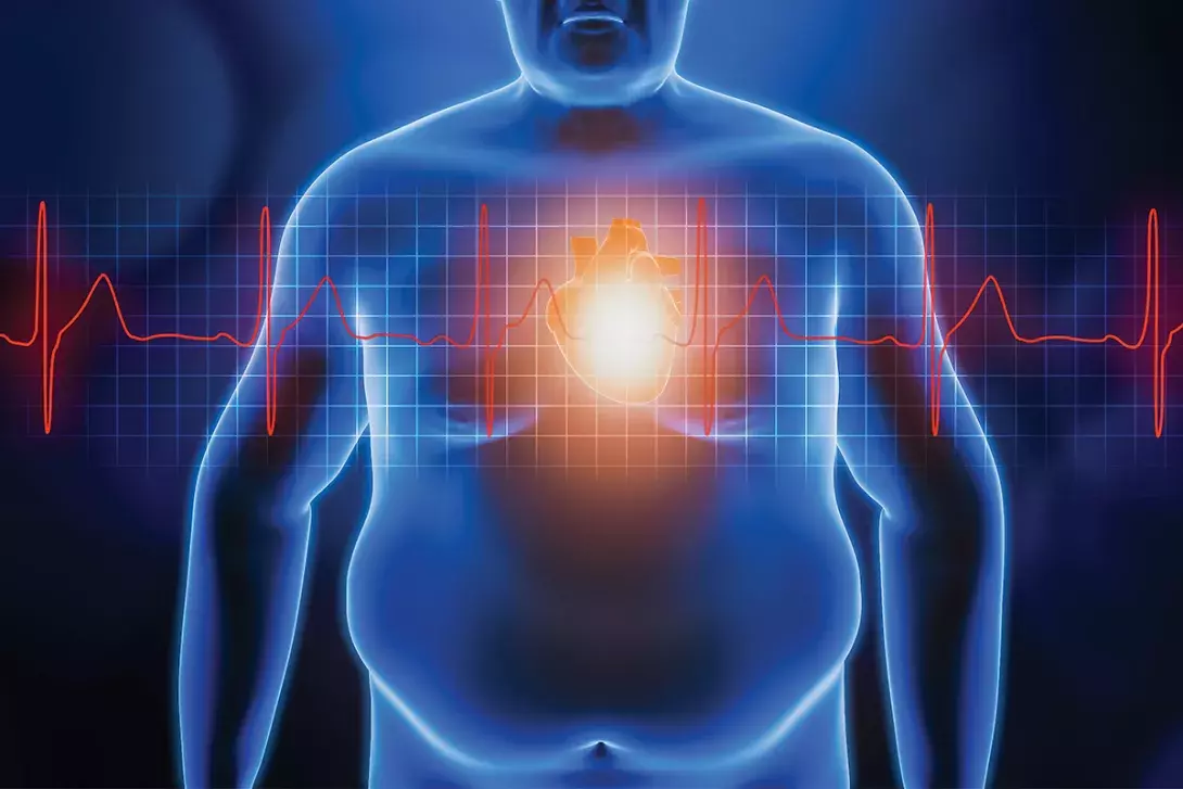 Obesity, atrial fibrillation and cardiovascular risk: a classic trifecta