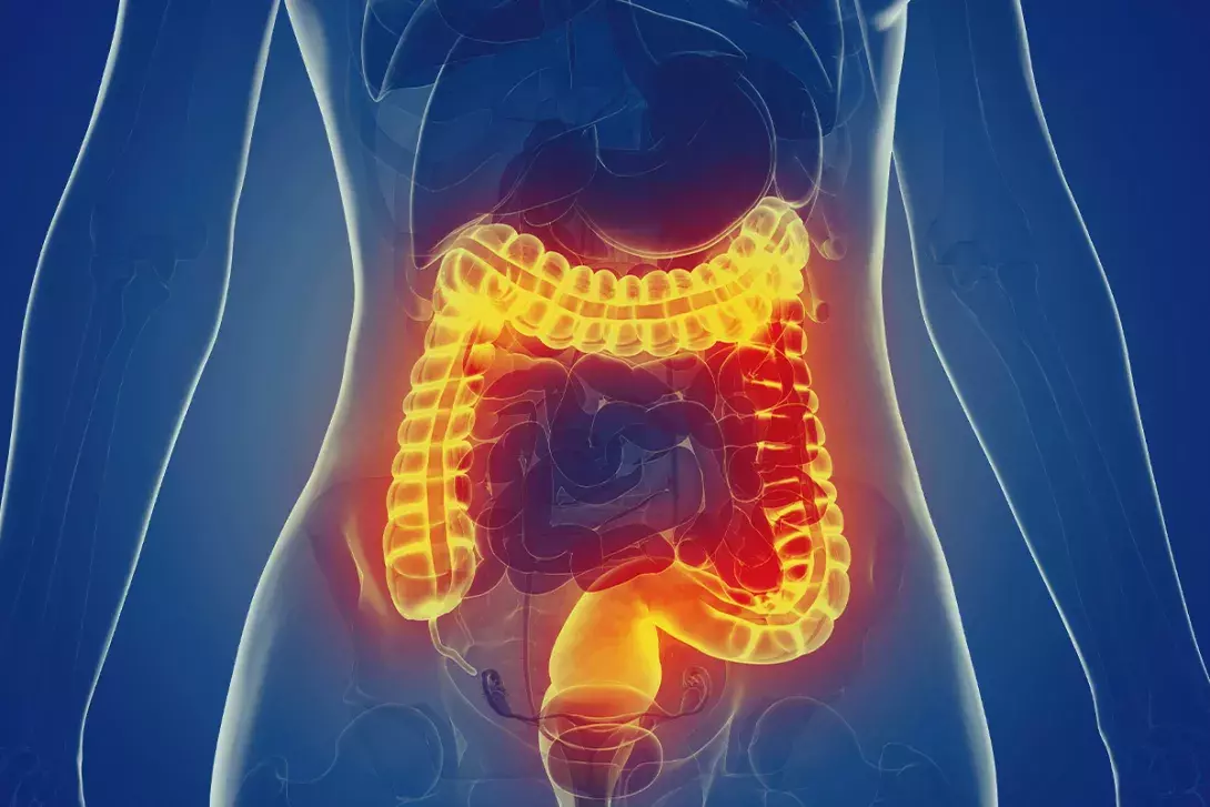 Crohn's Disease & Colitis  Associated Gastroenterology in Orange