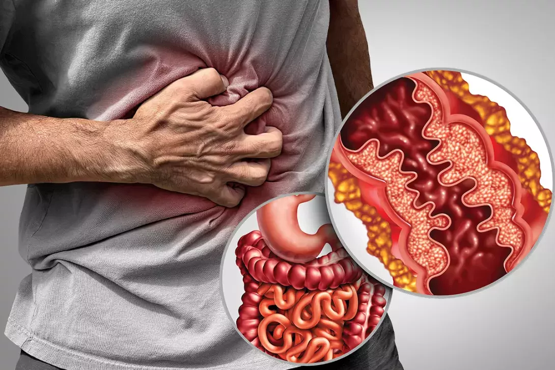 About Crohn's Disease – Crohn's & Colitis Australia (CCA)