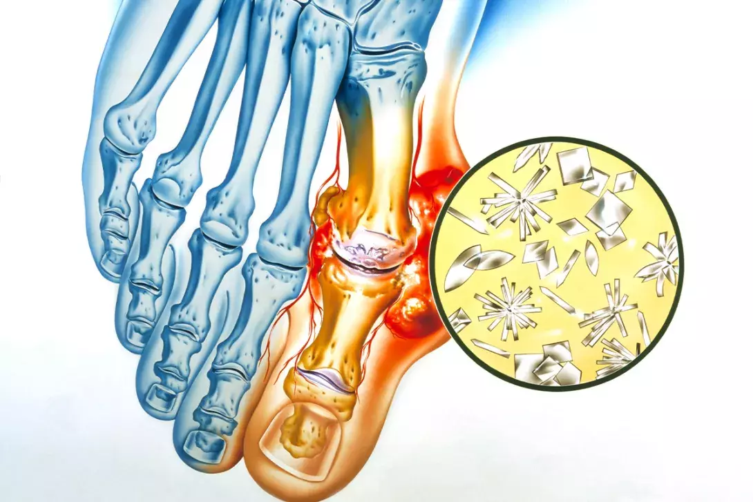 Crystal arthritis – managing gout and calcium pyrophosphate deposition ...